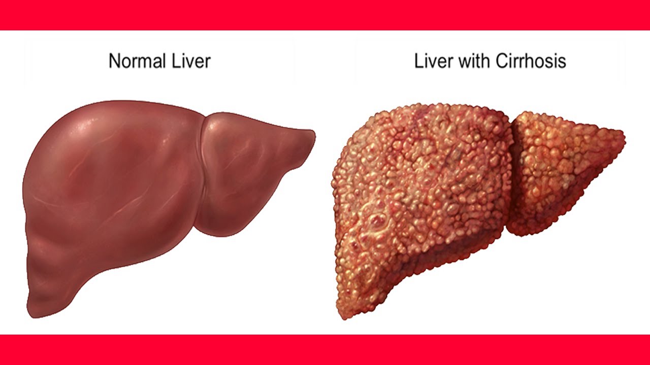 Is Tea Bad For Liver Cirrhosis