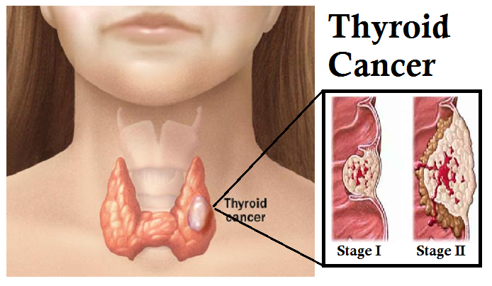 Image result for Thyroid Cancer