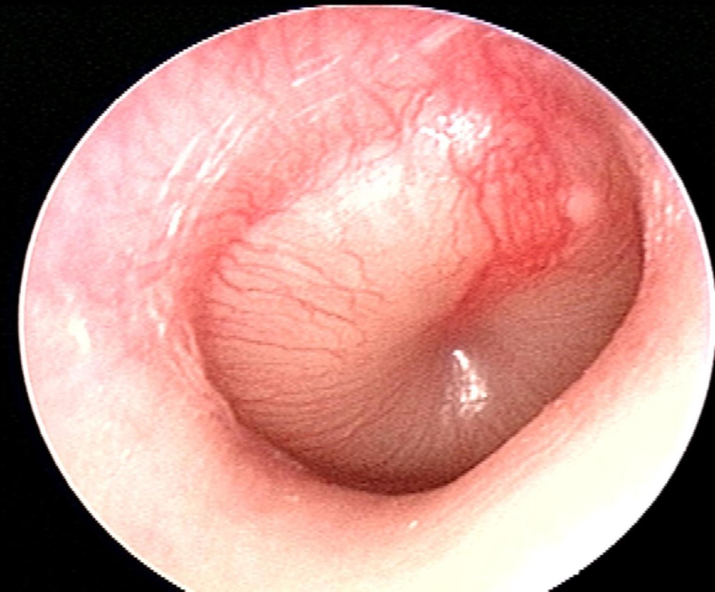 Otitis Membrane Assessment Tympanic Membrane