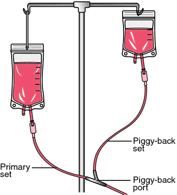 Piggyback system for intravenous therapy used in the hospital of the