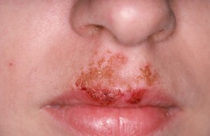 impetigo