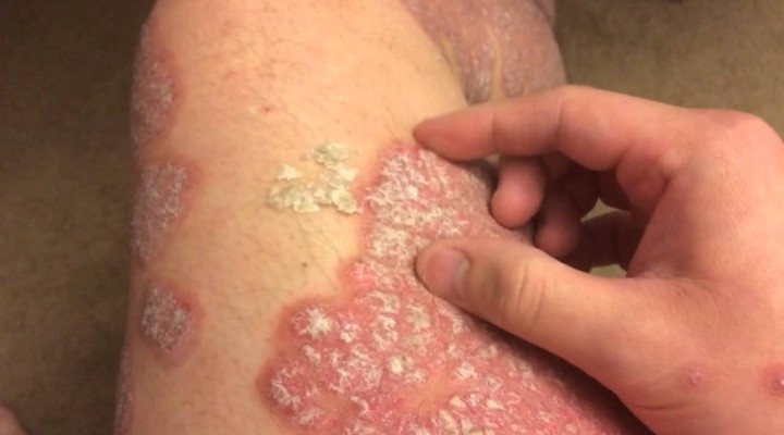 nursing care of patients with psoriasis)