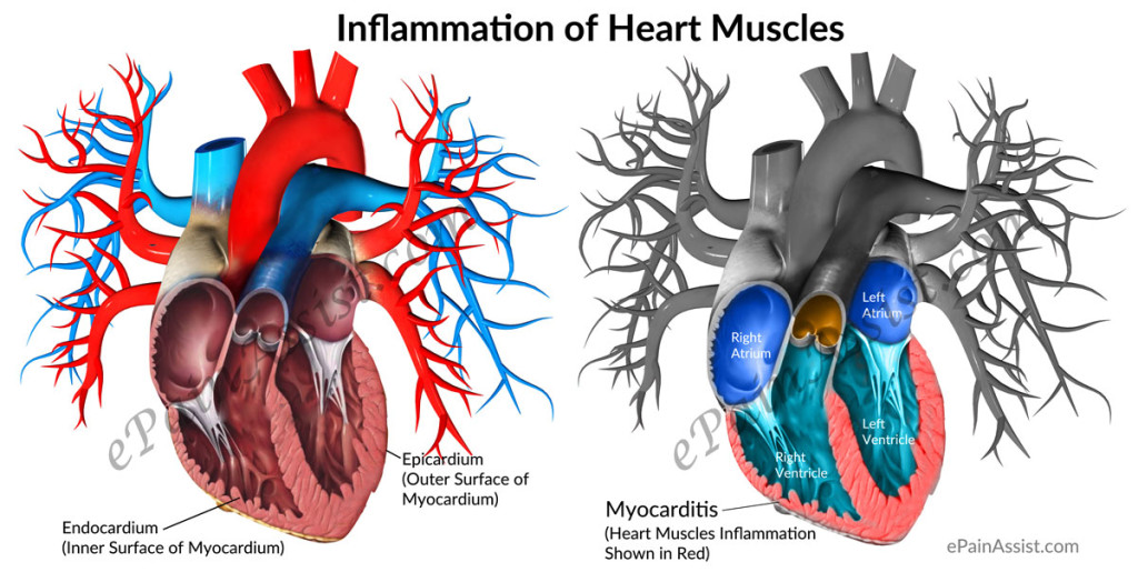 myocarditis