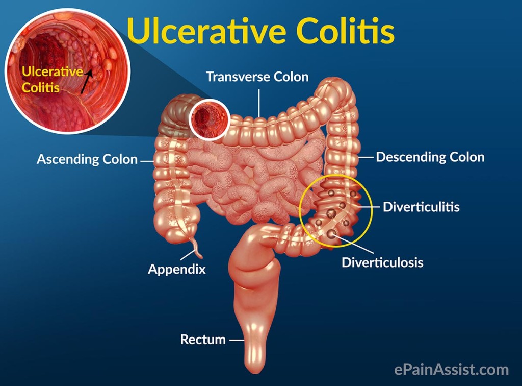 ulcerative collitis