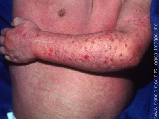 Seborrheic Dermatitis  Symptoms & Treatment - Skinsight