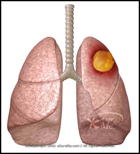 Lung Abscess