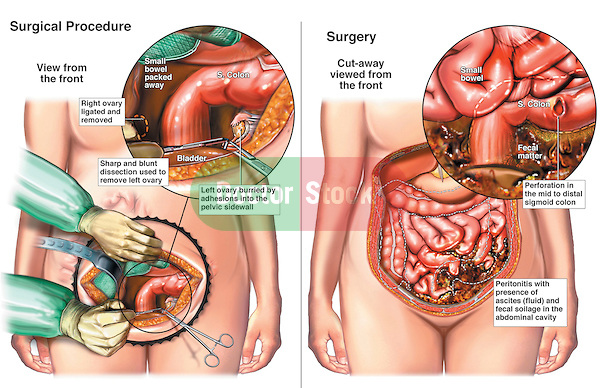 Bilateral Salpingo-oophorectomy with Perforation of the Colon. This medical illustration series shows an intra-operative view during a bilateral salpingo-oophorectomy surgery (removal of the ovaries). The second image reveals a post-operative bowel colon perforation and contamination of the abdomen by fecal contents.