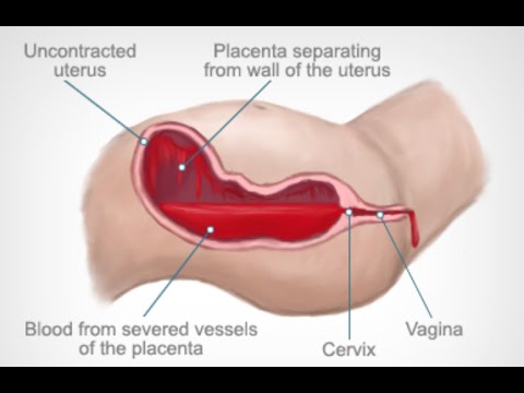 Nursing interventions for Post-partum HemorrhageNursing File