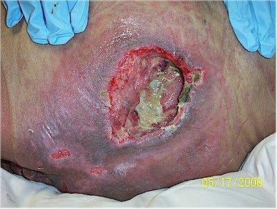 stage-4-decubitus-ulcer