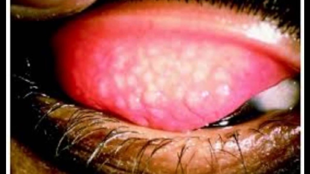 trachoma