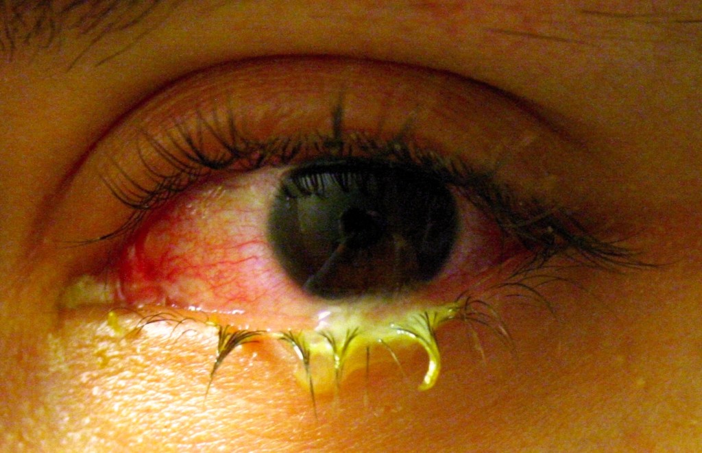 conjunctivitis